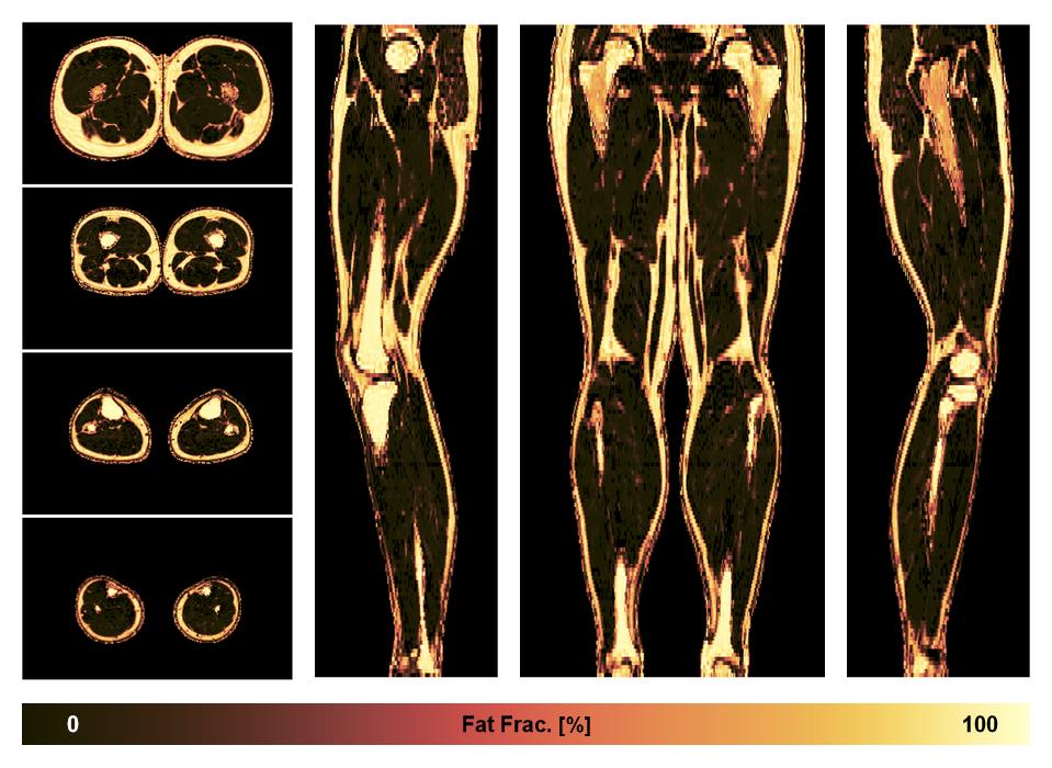 The fat fraction of the lower extremity obtained from the dixon reconstruction for muscle water fat quantification.